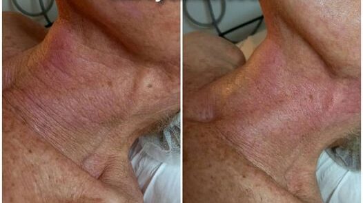 Radiofréquence diathermique