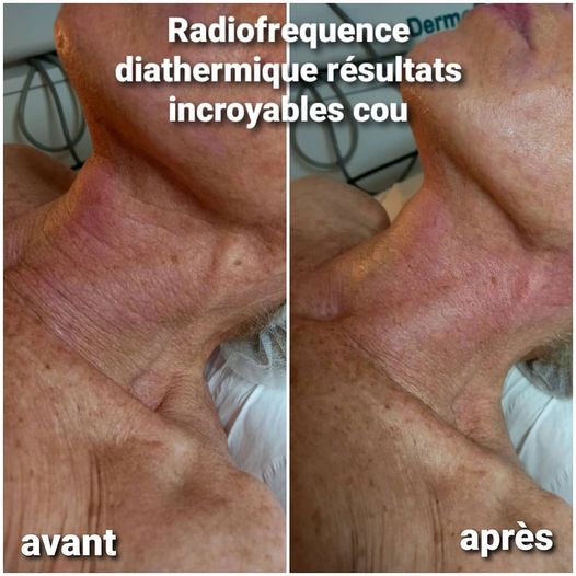 Radiofréquence diathermique