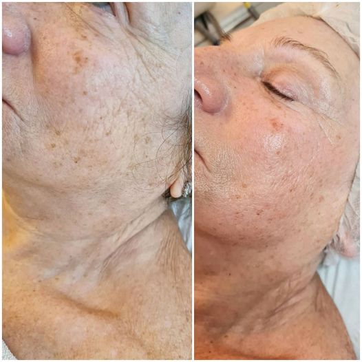 radiofréquence visage