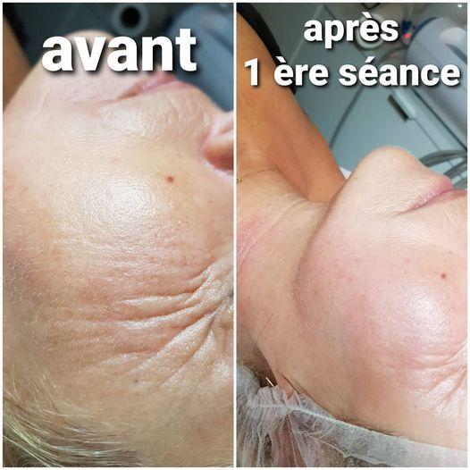 radiofréquence visage